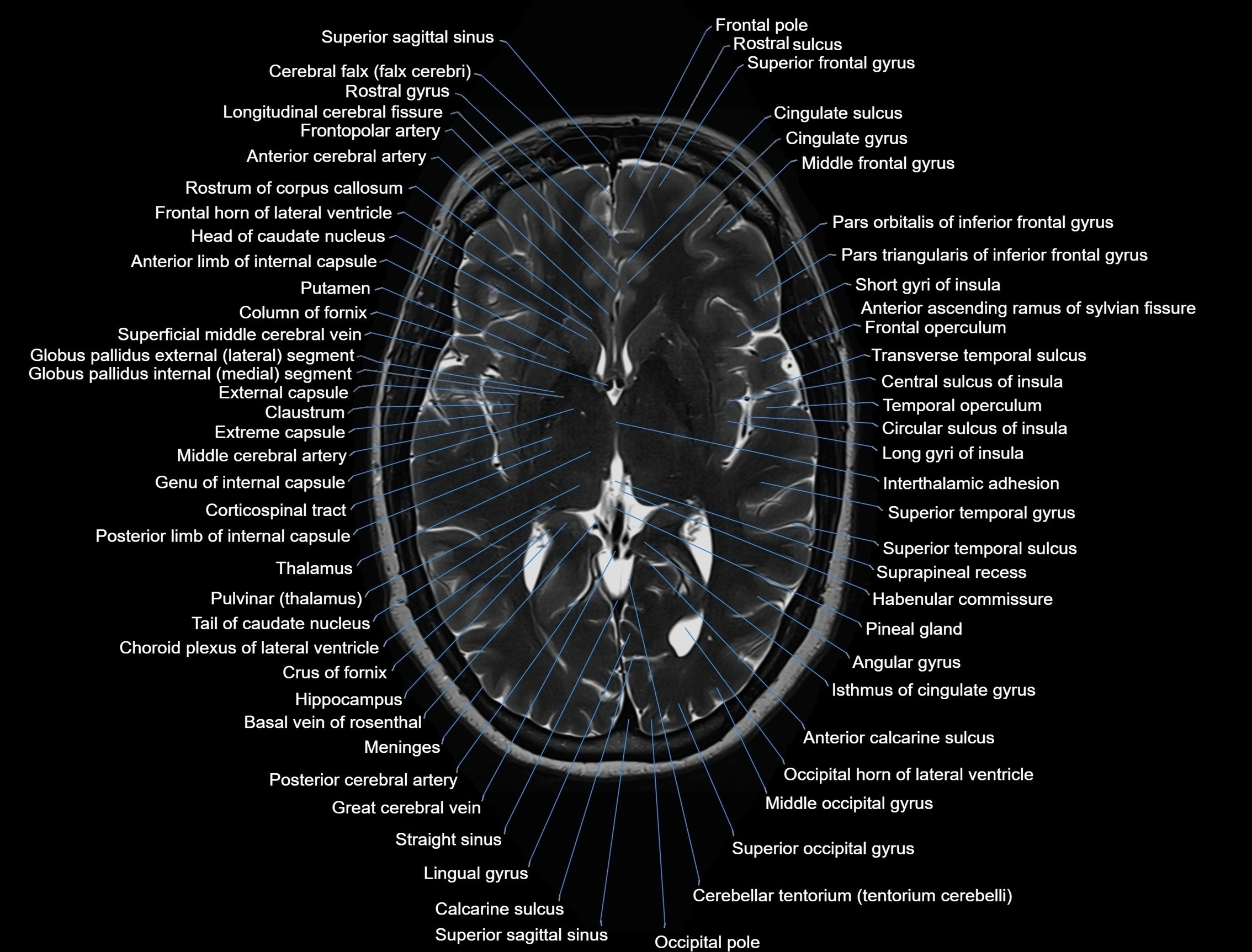 MRI Brain axial cross sectional radiology anatomy 3T image  -img-00001-00029.webp